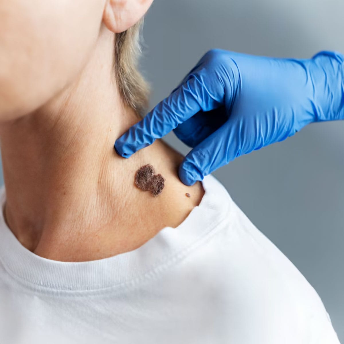 Professional skin screening Dermatologist performing professional skin check examination on patient's mole
