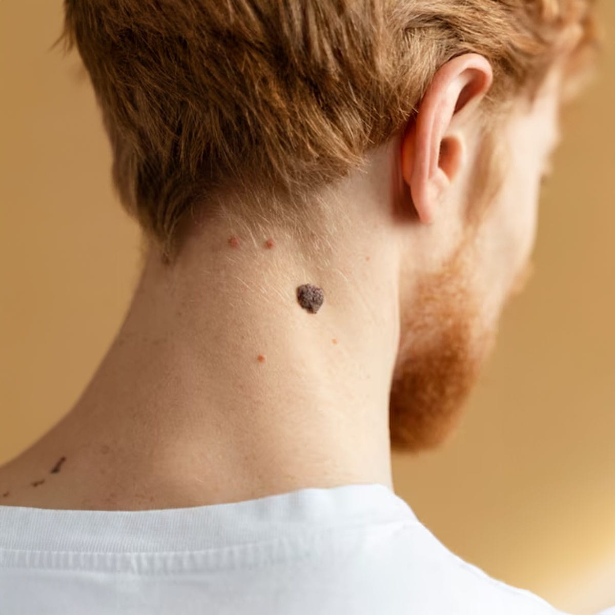 Melanoma risk assessment Close-up dermatological examination of pigmented skin mole showing irregular borders