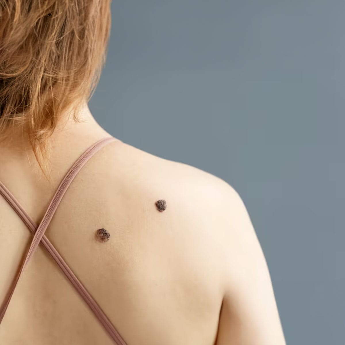 All About Moles: Identification, Risks, and When to See a Dermatologist