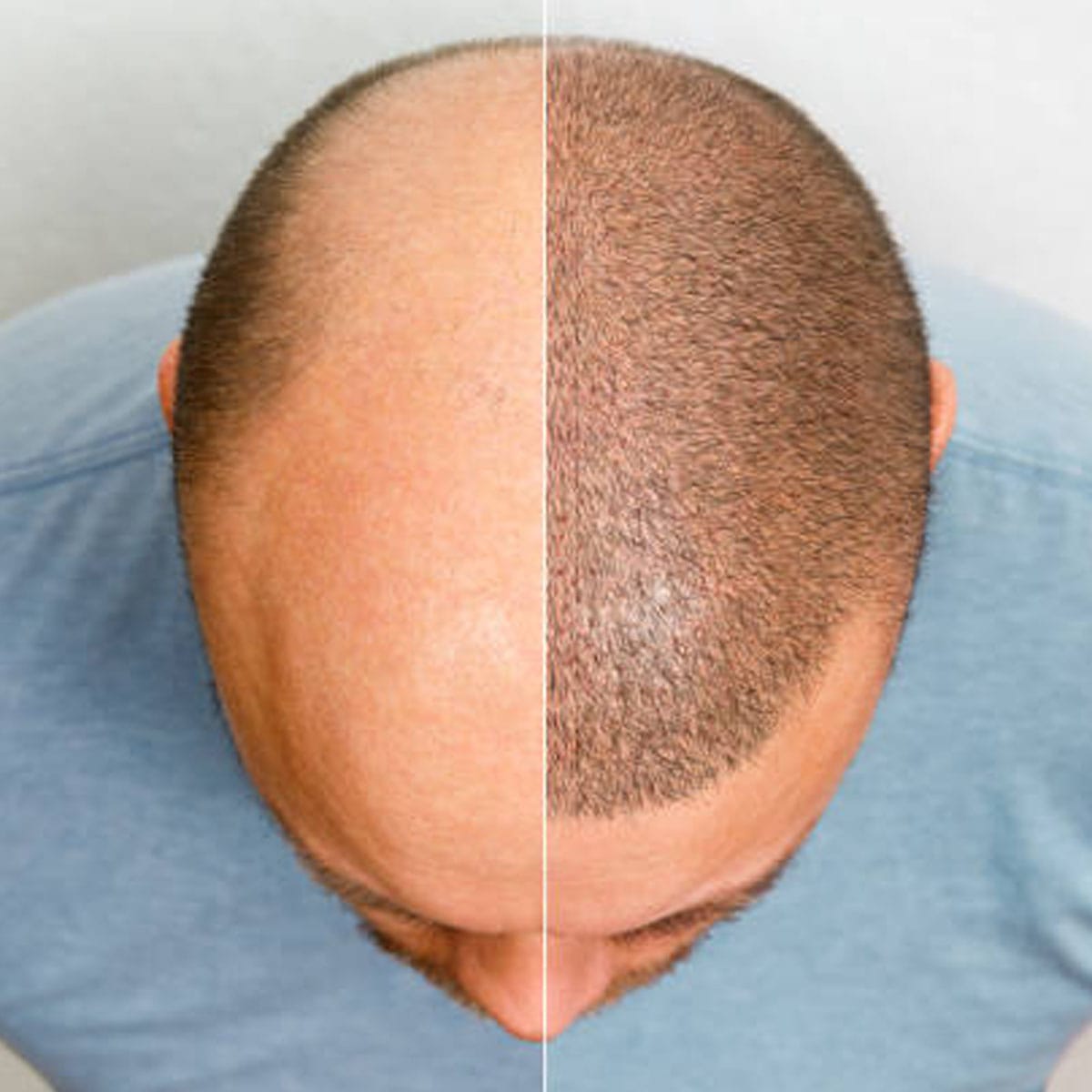 hair transplant cost UK, FUE hair transplant price, hair transplant London cost