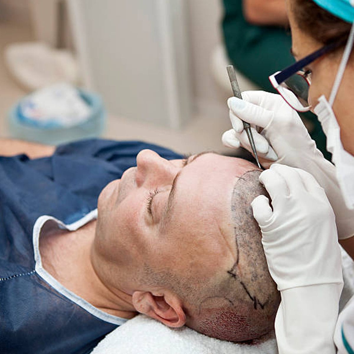 hair transplant cost UK, FUE hair transplant price, hair transplant London cost