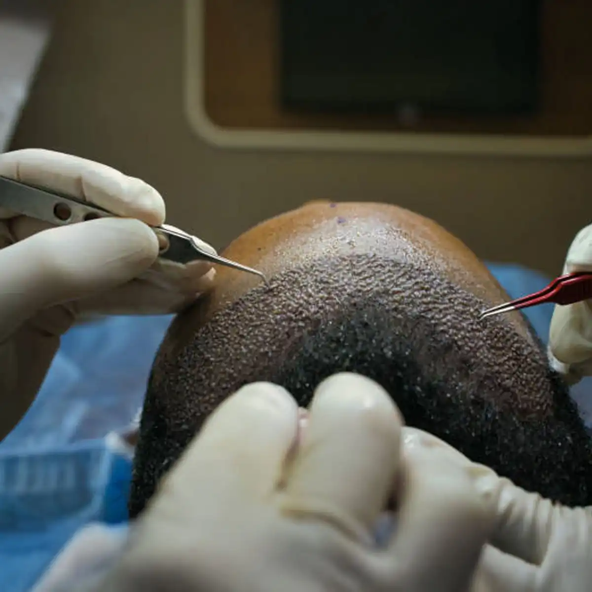 How Much Does a Hair Transplant Cost in the UK? Pricing, Factors & What to Expect